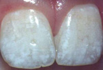 Teeth with Dental Fluorosis caused by Fluoride